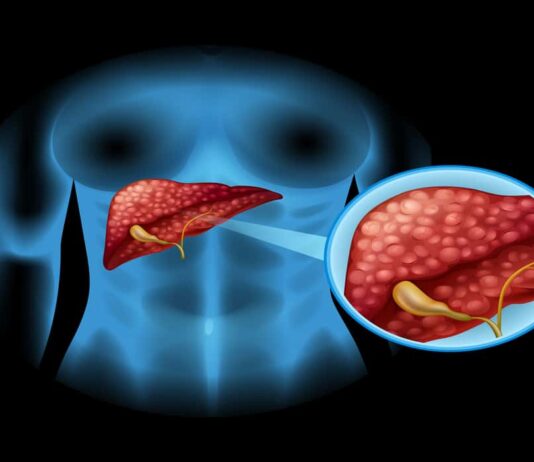 hepatitis