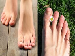 Ingrown toenails – কুনি নখ