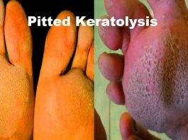 pitted-keratolysis-home-remedy
